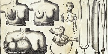 Rintasyövän pelkoja Englannissa 1700-luvulla